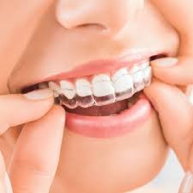 Invisalign